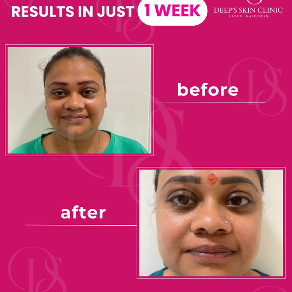 Japanese Pigmentation & Dark Spot Correction Cream – Day cream - Deep’s Skin Clinic