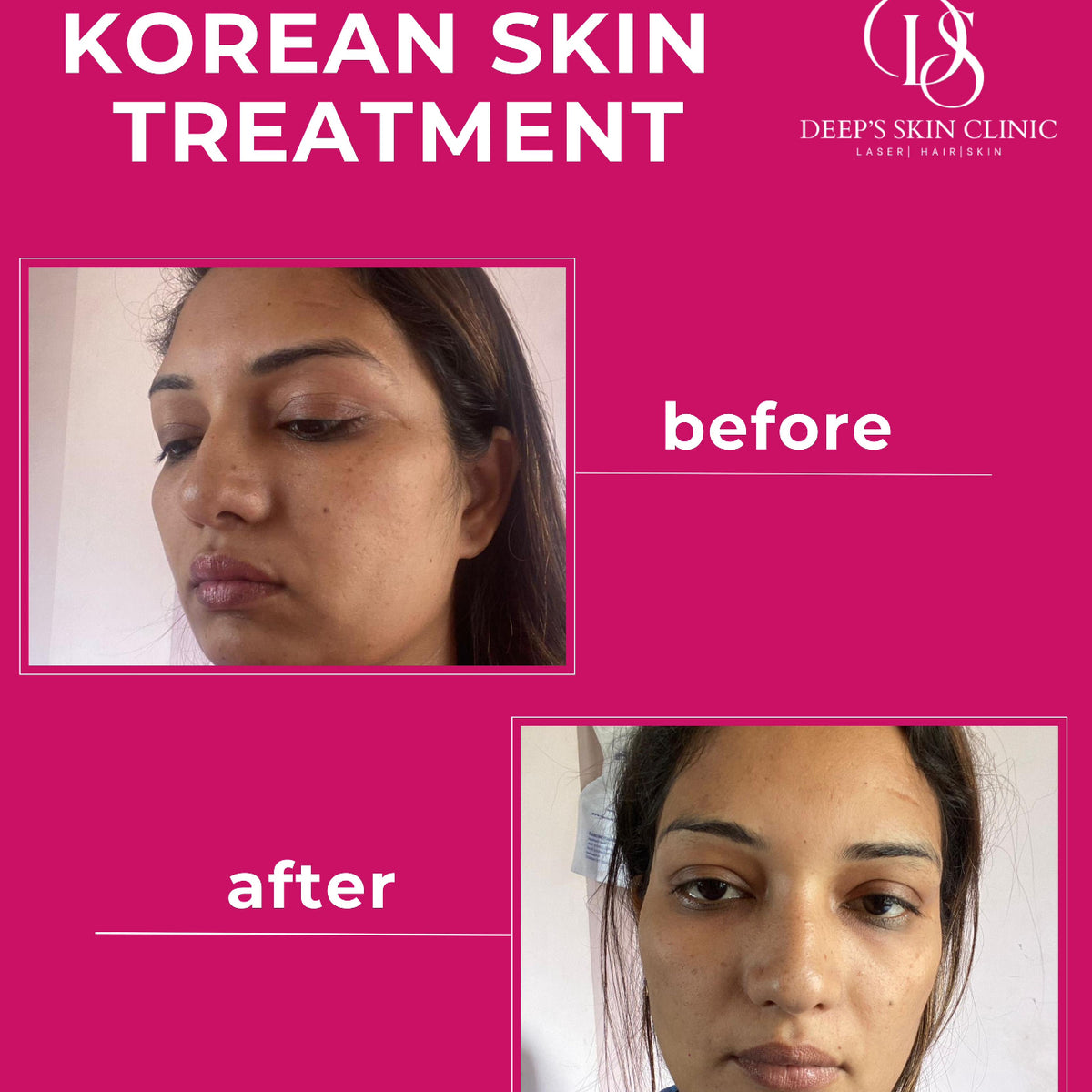 Whitening Combo pack - Deep’s Skin Clinic